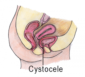 cystocele_prolapse