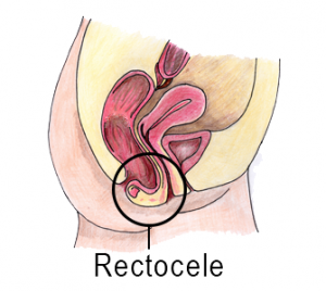 fecal incontinence through bowel prolapse