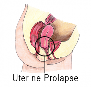 uterine_prolapse